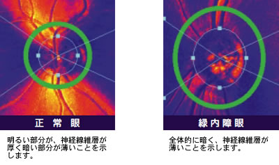 正常眼：明るい部分が、神経線維層が厚く暗 い部分が薄いことを示します。緑内障眼：全体的に暗く、神経線維層が薄いこ とを示します。