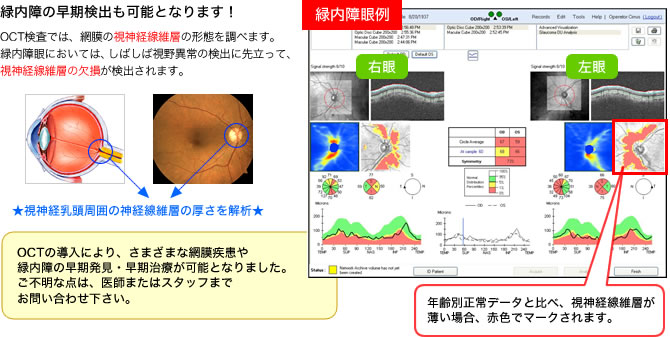 緑内障の早期検出も可能となります！OCT検査では、網膜の視神経線維層の形態を調べます。 緑内障眼においては、しばしば視野異常の検出に先立って、視神経線維層の欠損が検出されます。